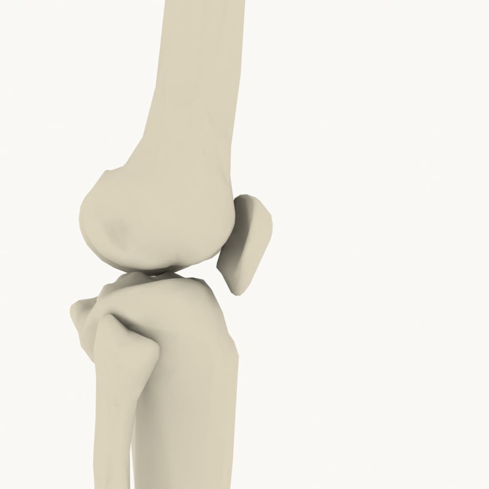 Rechtes Knie von lateral mit vier gestrichelten Femur-Achsenspuren, die gegeneinander verkippt durch die Kondylenregion laufen